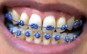 traditional stainless steel braces