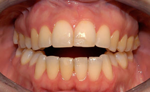 lakewood orthodontist openbite