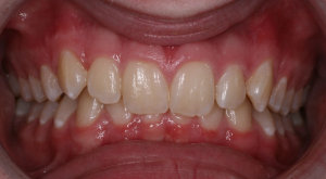 lakewood orthodontist overbite